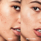 SKIN Blemish Breakthrough Acne Fighting Spot Gel, Roll-On for Treating Blemishes, Made with Salicylic Acid, Vegan & Cruelty-Free
